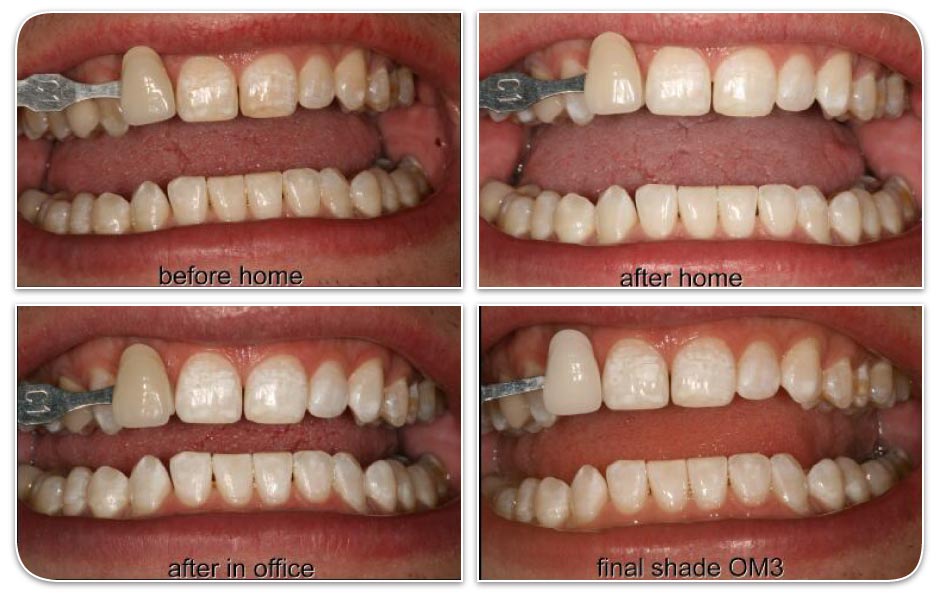 image of home teeth whitening vs professional whitening
