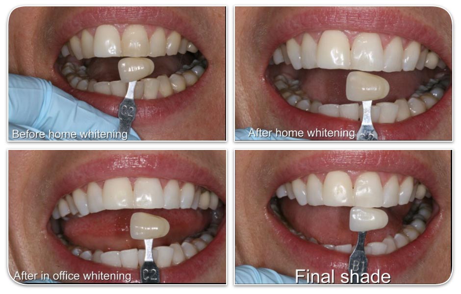 home teeth whitening vs professional whitening