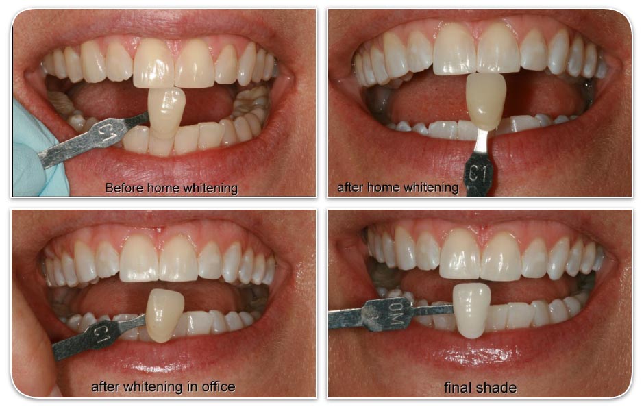 photo collage of before/after teeth whitening