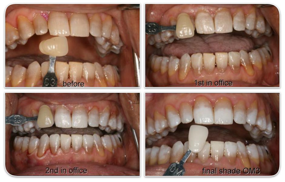 before and after of in-office teeth whitening