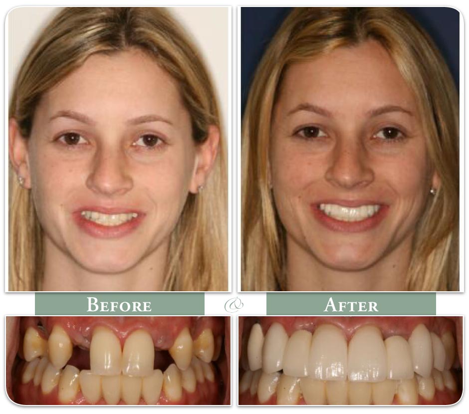 dental implant before and after
