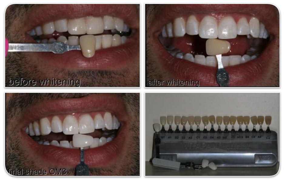 before and after teeth whitening