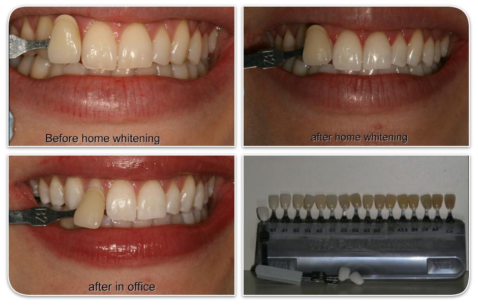 before and after home and office teeth whitening