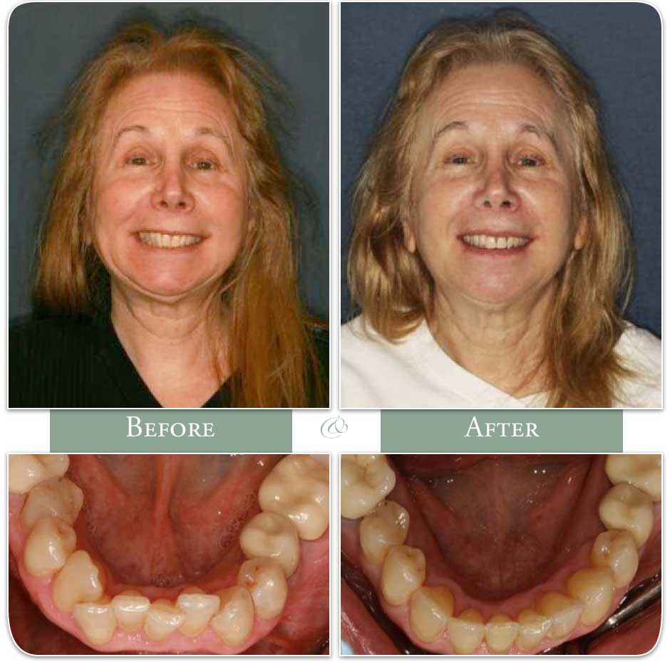 a woman's teeth before and after invisalign treatment