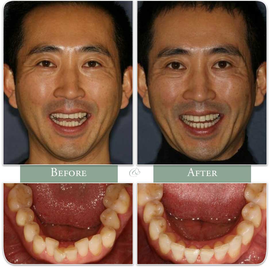 before and after invisalign treatment of patient