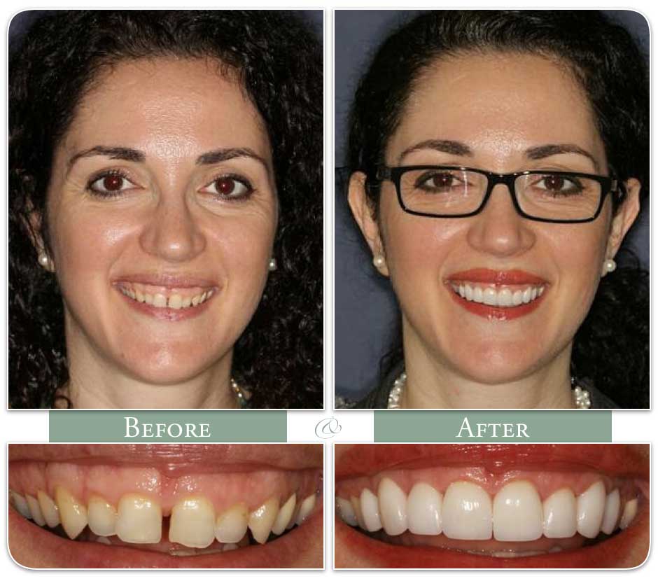 successful invisalign treatment before and after