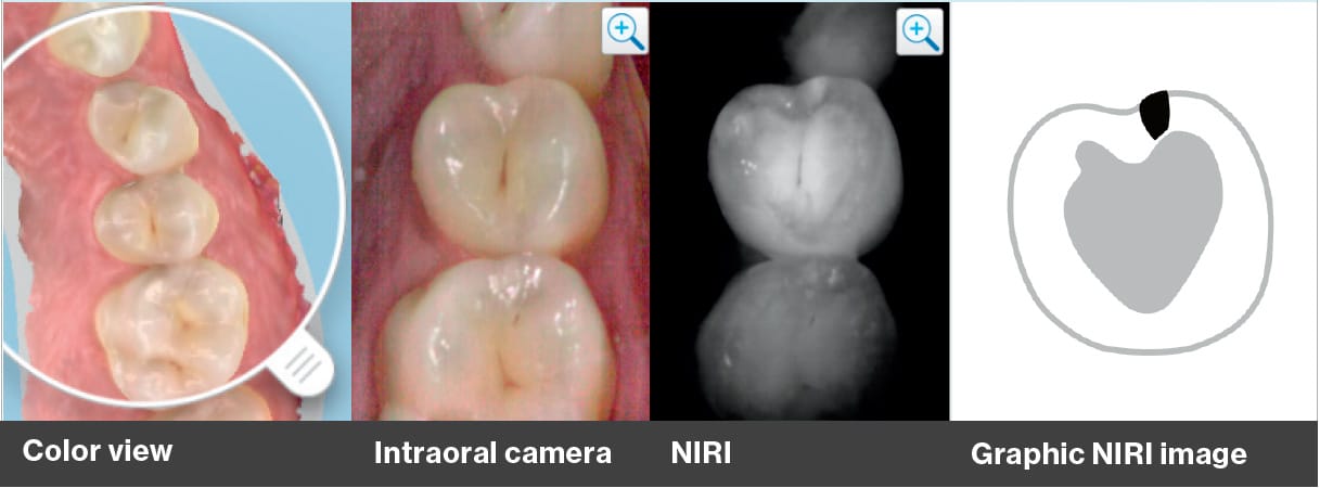 Itero 5d Tooth Imaging Photo