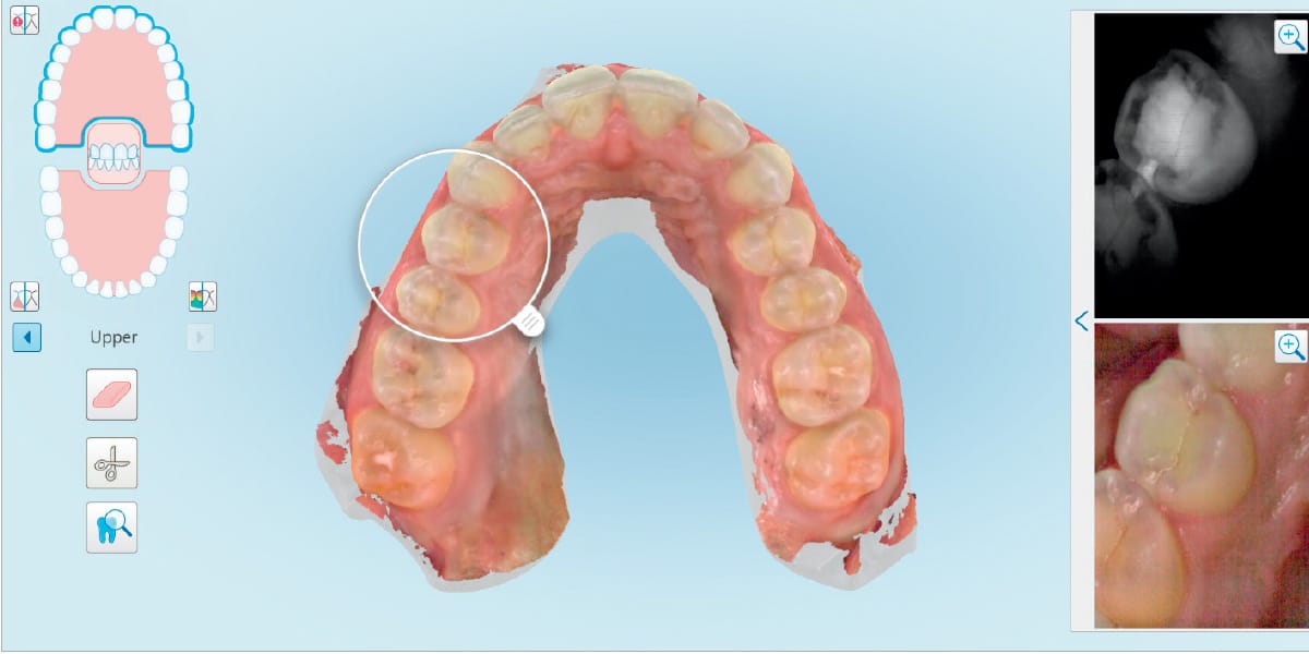 Itero 5d Tooth Imaging Photo