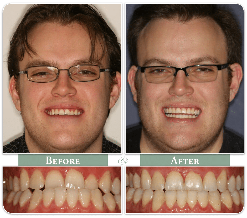 before and after Invisalign images