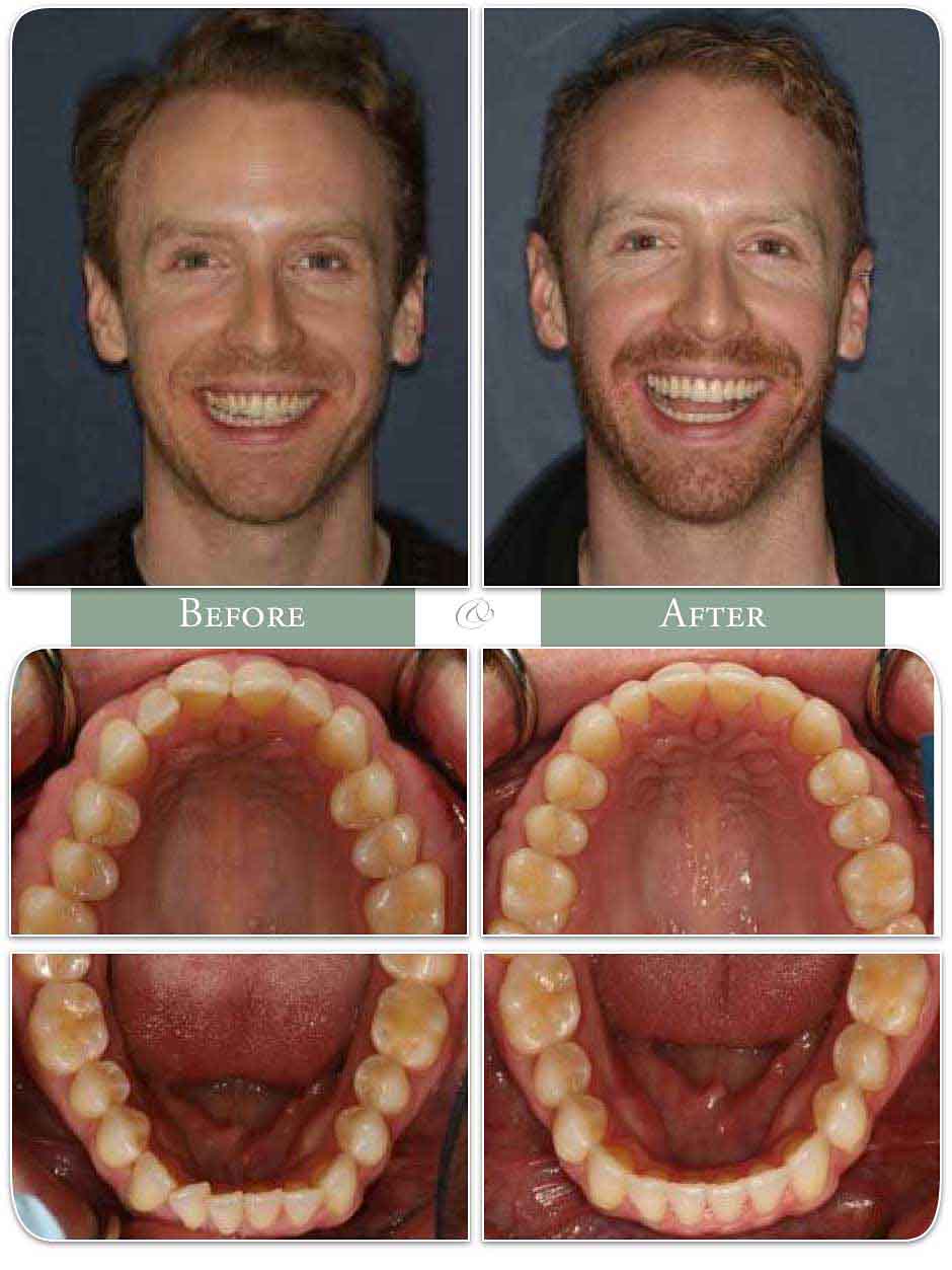 before and after images of a smiling man's teeth straightened with Invisalign