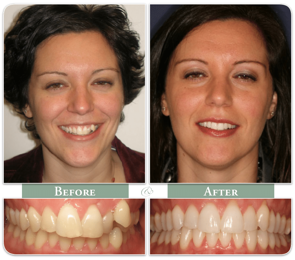 before and after invisalign straightening treatment