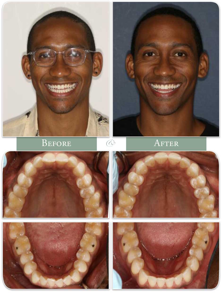 before and after images of a man's teeth straightened with invisalign