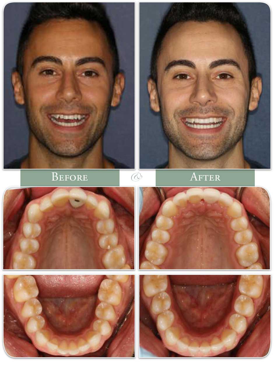 before and after of invisalign for crooked teeth