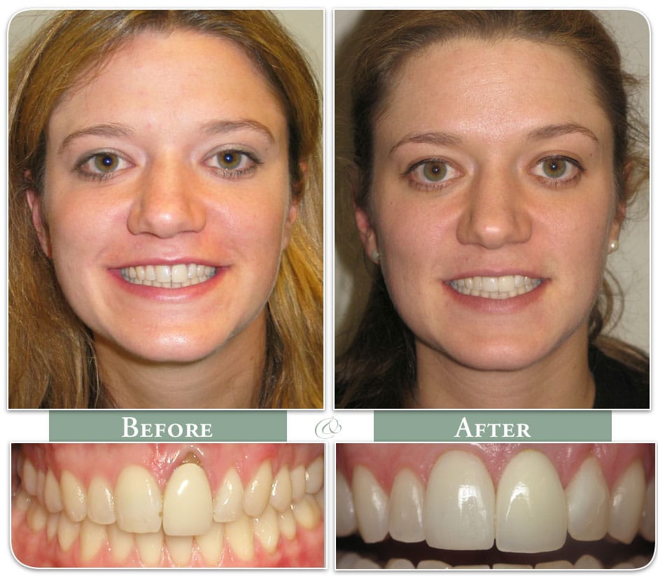 before and after of patient dental implants