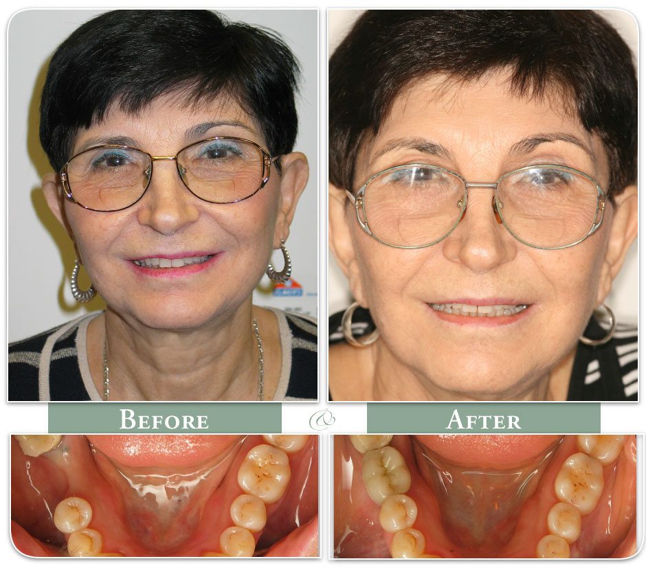 happy before and after of dental implants