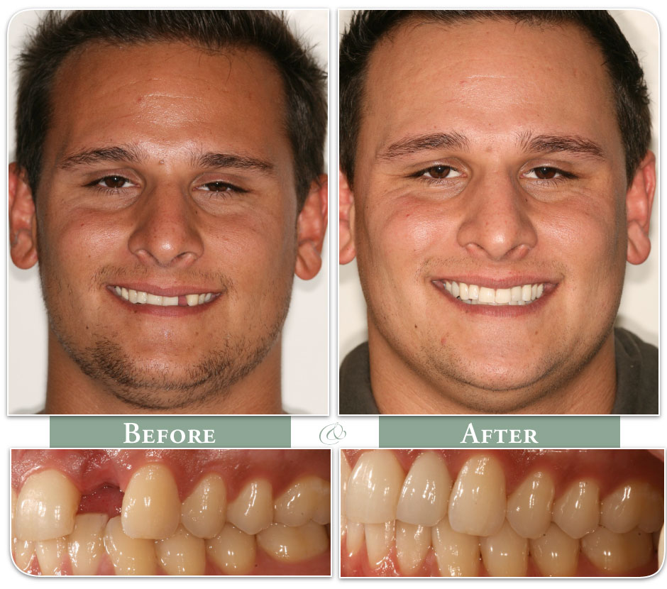 before and after of patient dental implants