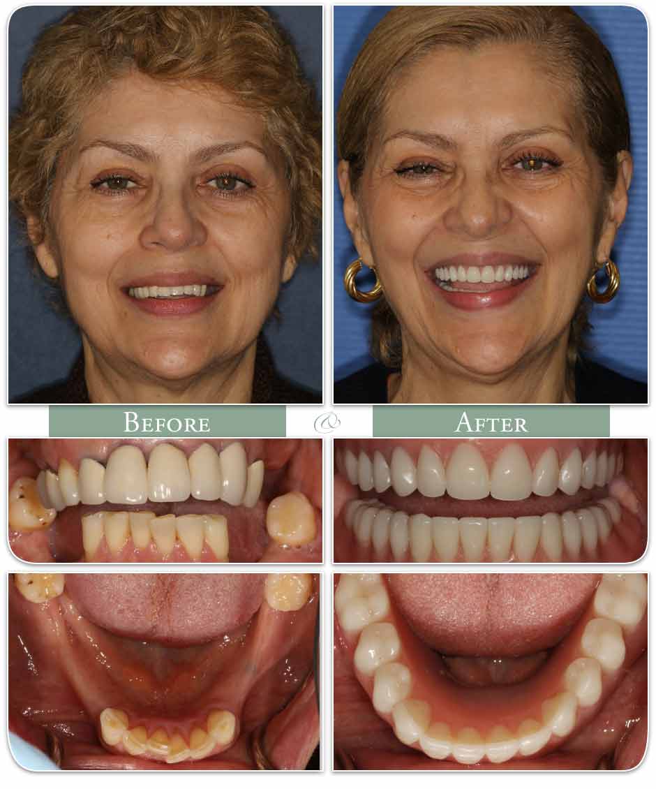 successful dental implant case photo