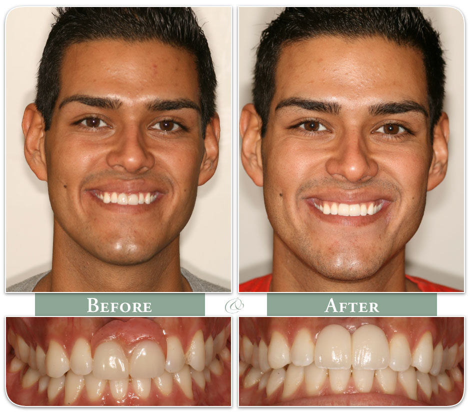 successful dental implants on smiling patient