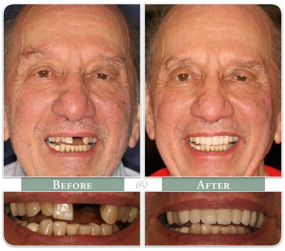 smiling before and after with new dental implants