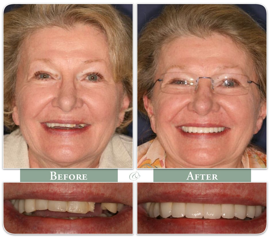 mature woman displaying her teeth before and after dental implant