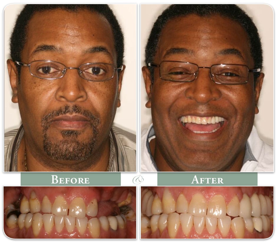 happy man displays his teeth before and after dental implants