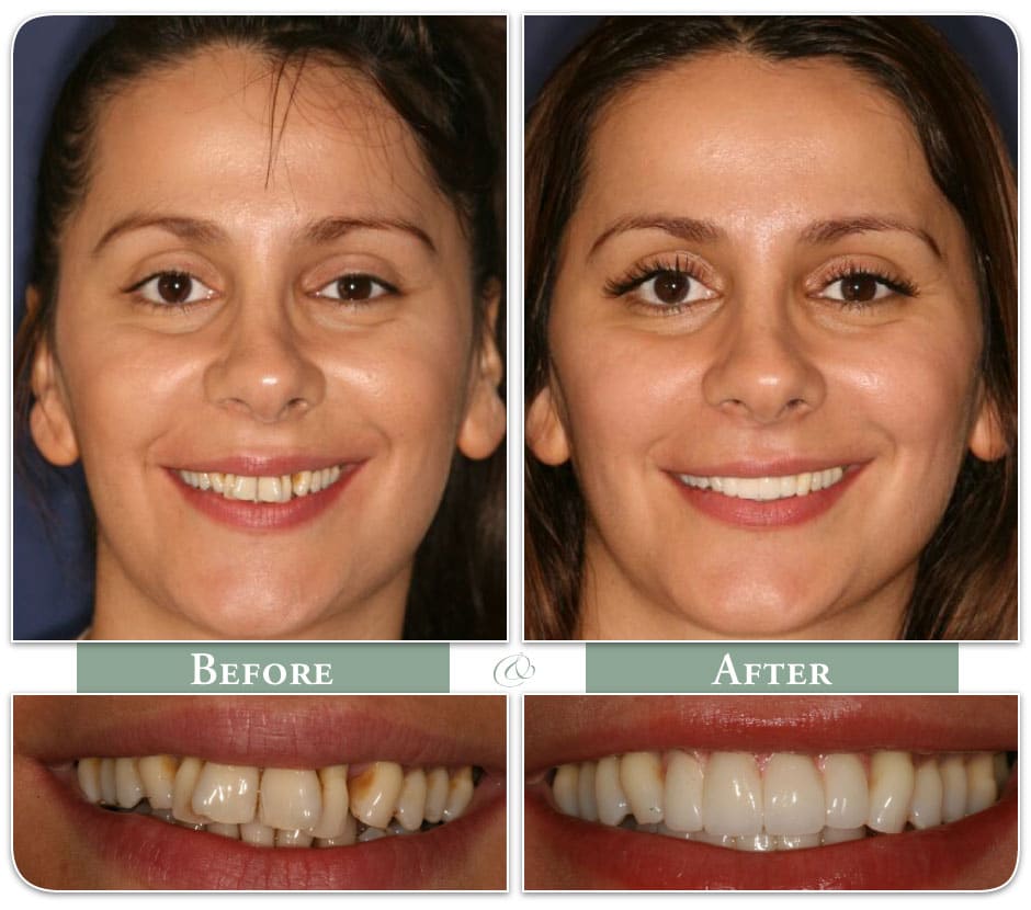 before and after photo of dental implant patient