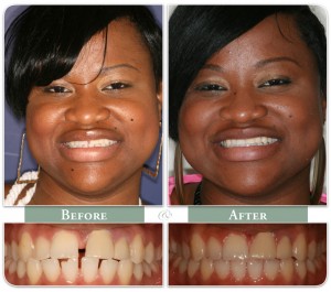 woman shows before and after results of Invisalign