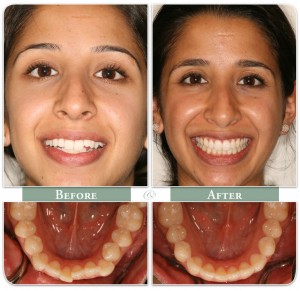 before and after of invisalign treatment