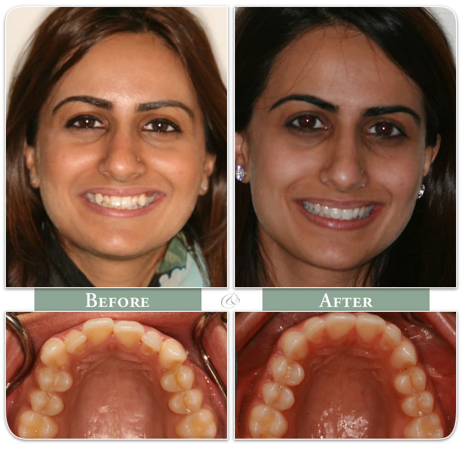before and after of successful invisalign treatment