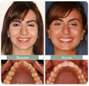 before and after of patient with invisalign