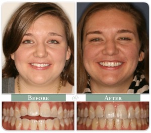 a woman shows her teeth before and after invisalign