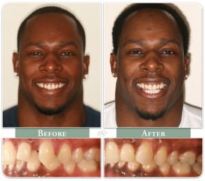 smiling man shows teeth before and after invisalign