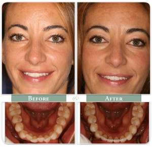 a woman displays her teeth before and after Invisalign treatment