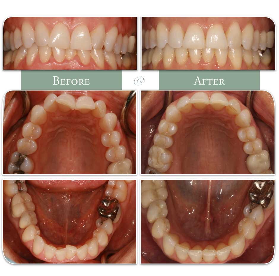 teeth before and after Invisalign