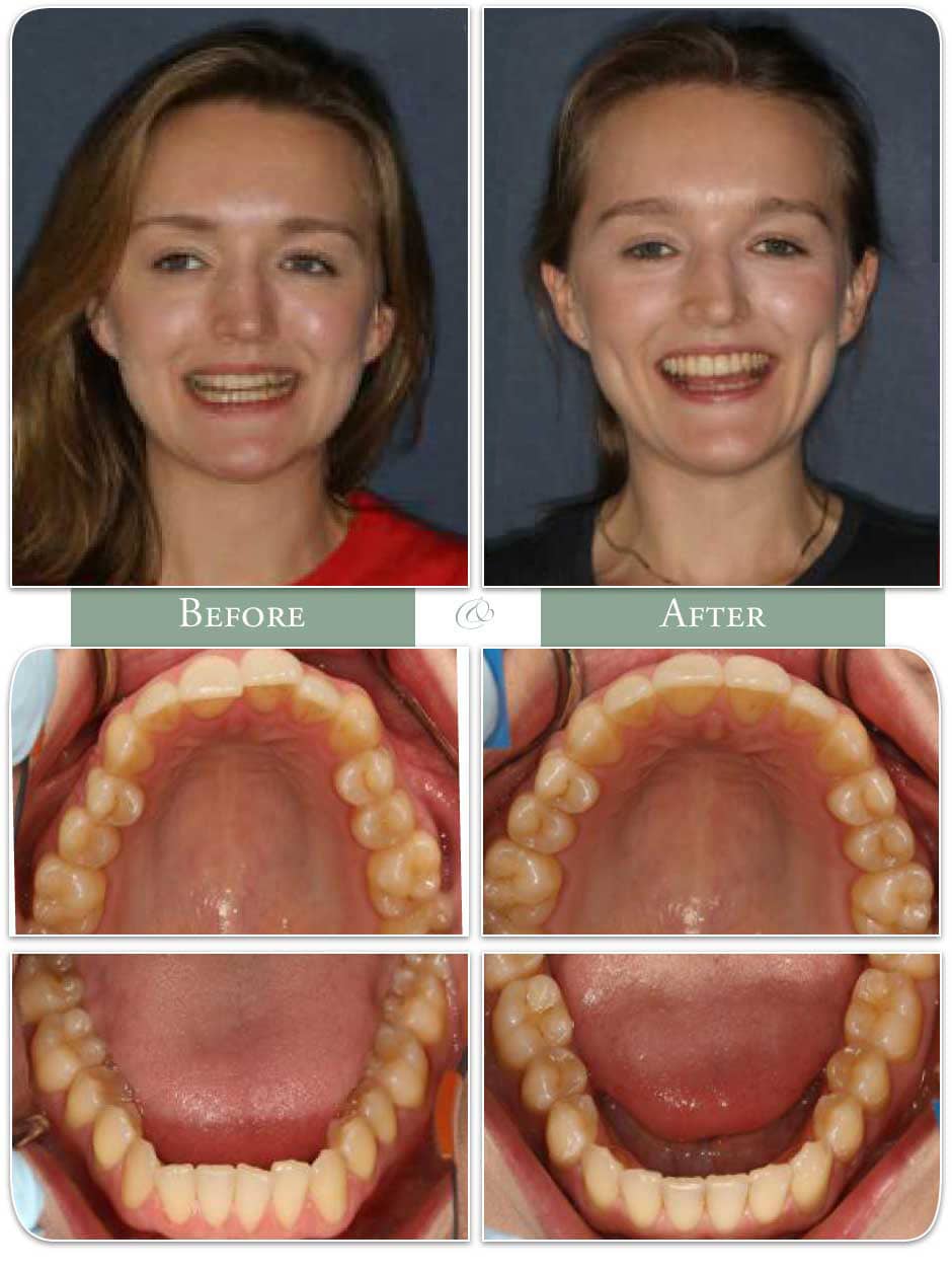 before and after images of teeth straightened with invisalign