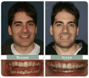 before and after invisalign treatment