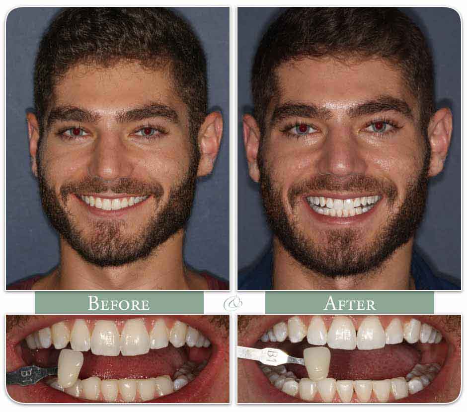 bearded man displays his teeth before and after whitening