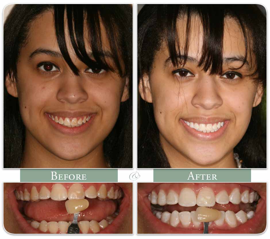 woman displaying her teeth before and after whitening