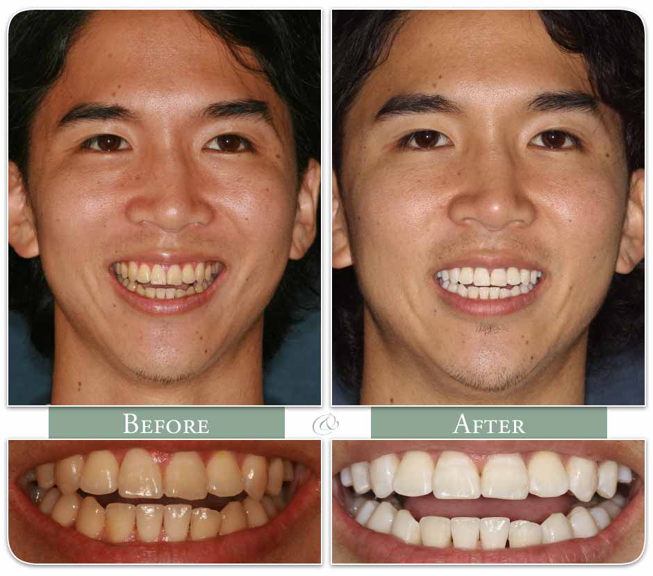 man displays teeth post-whitening