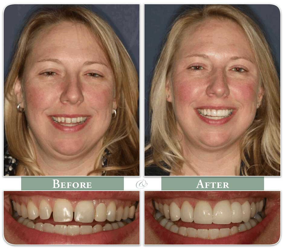before and after image of a woman with dental veneers case 18