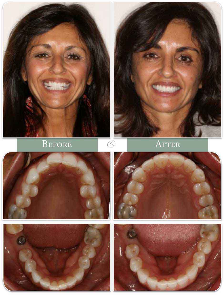 brunette woman displays teeth before and after Invisalign