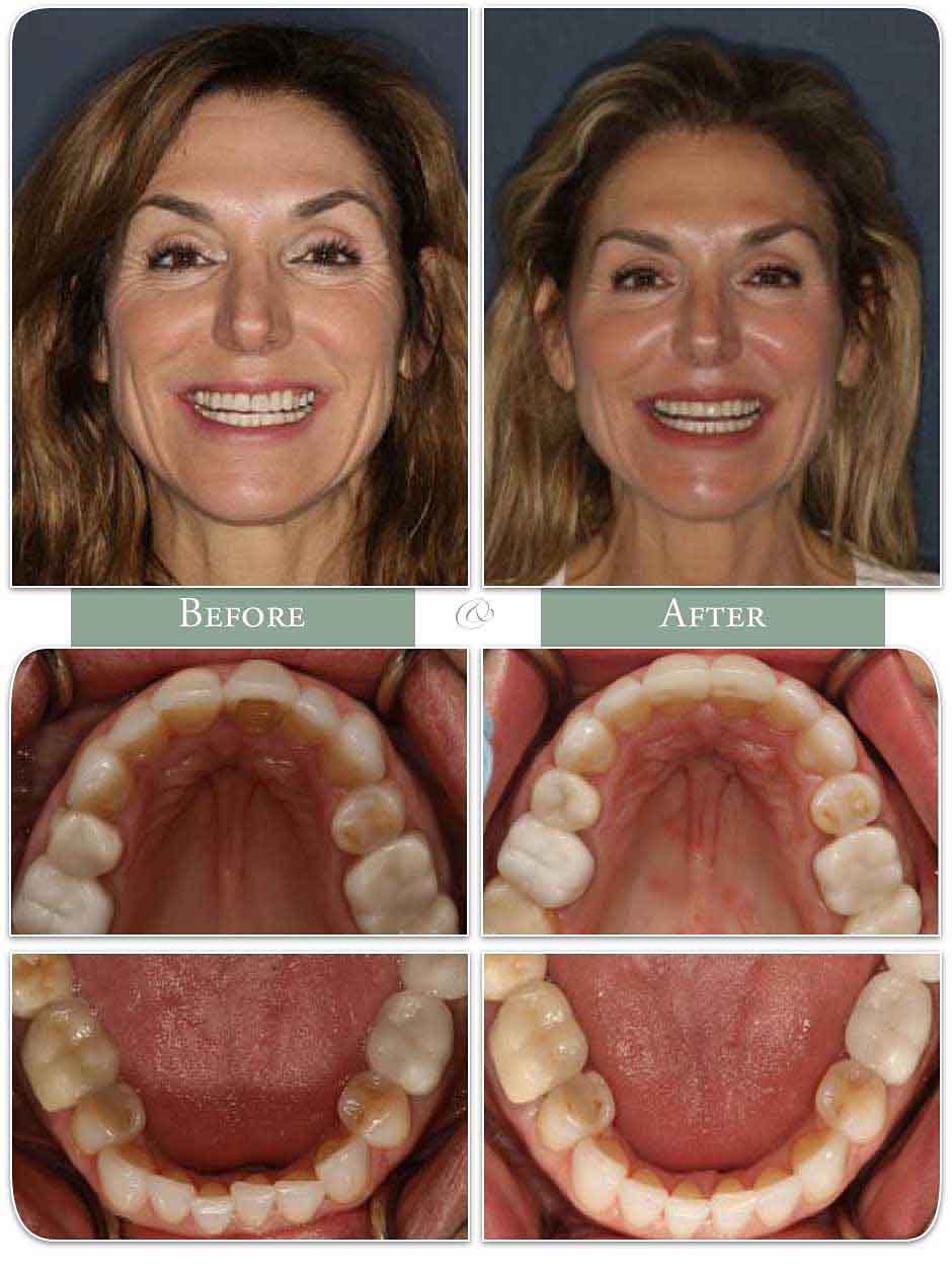 a woman displays her teeth before and after Invisalign