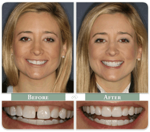 blond woman displays teeth before and after Invisalign