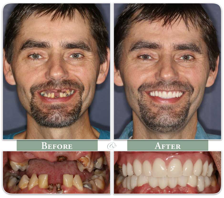 before and after of patient named mark