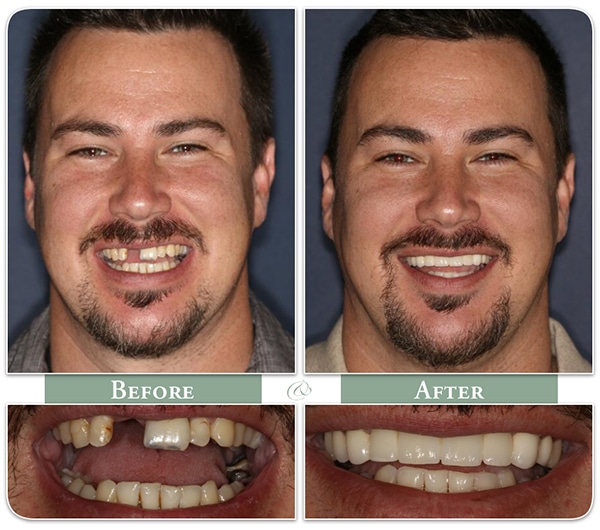 before and after photos of a man with a dental implant