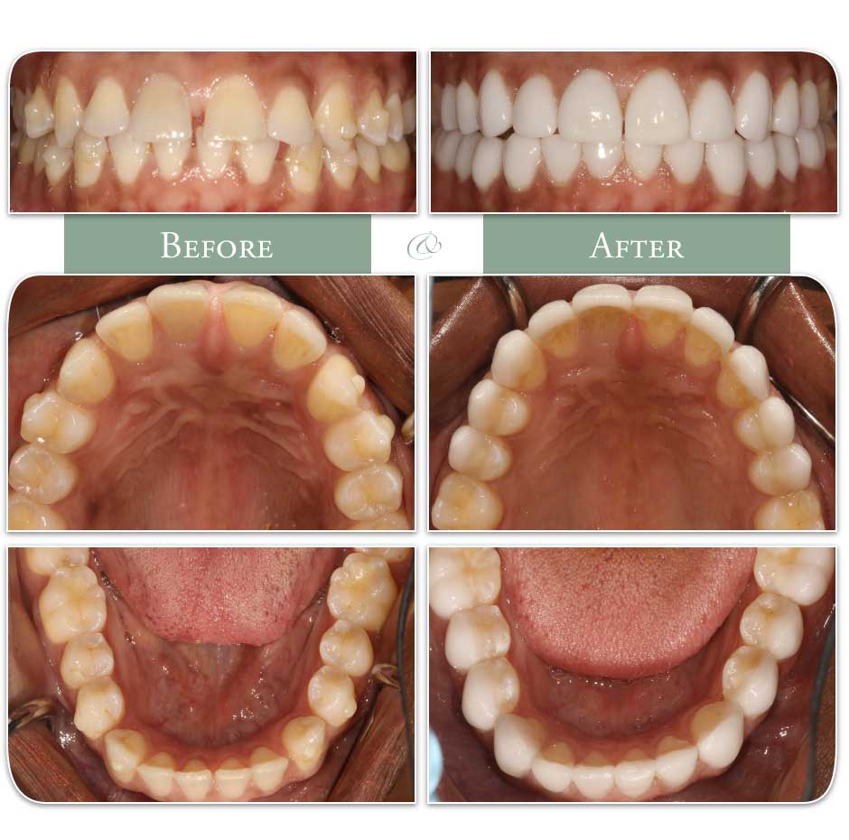 before and after images of teeth whitening