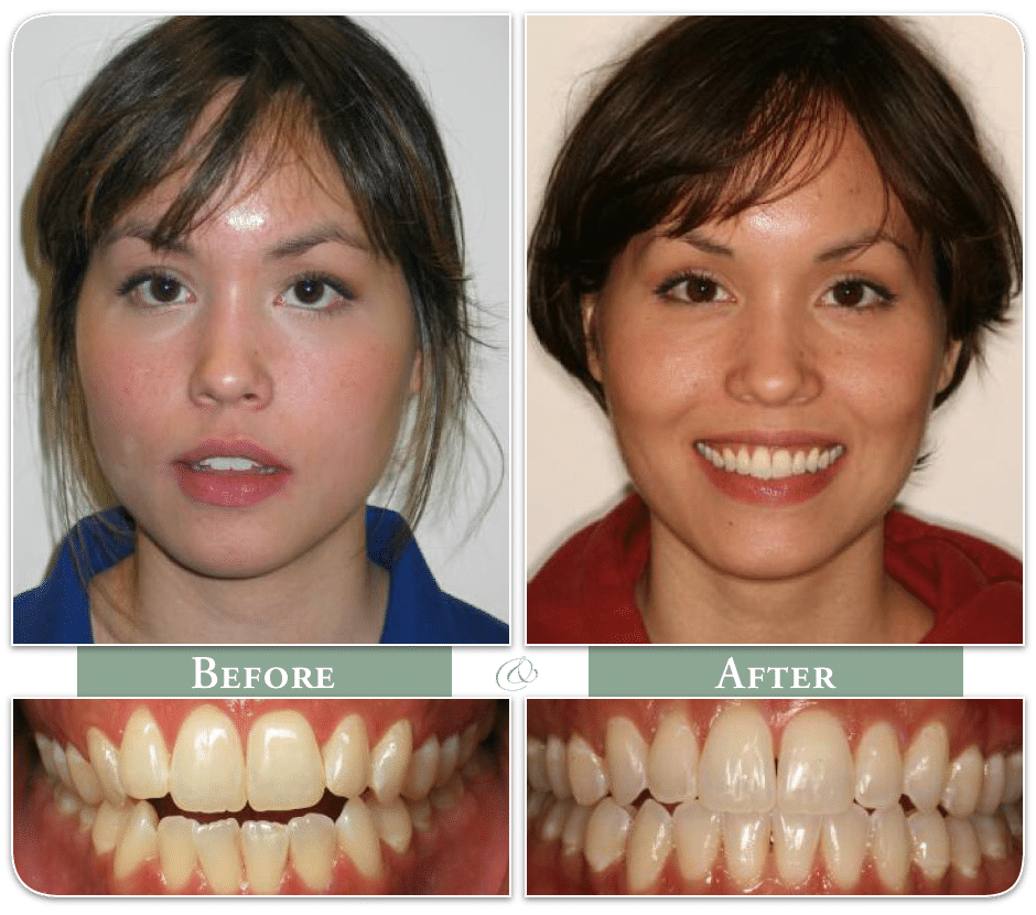 a woman displays her teeth before and after dental procedure