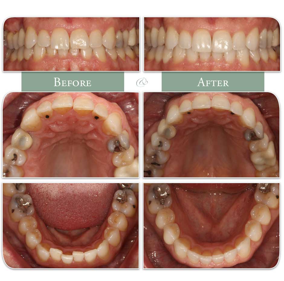before and after Invisalign photos