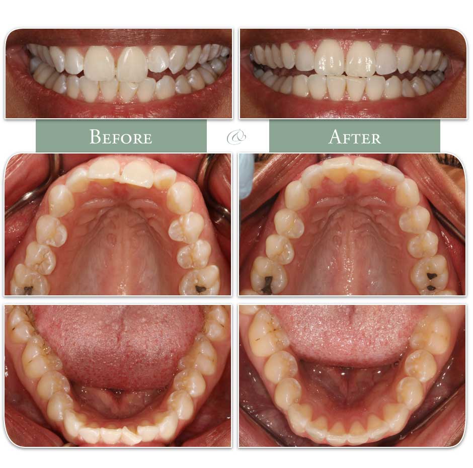 teeth pre and post Invisalign