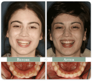 before and after dental work